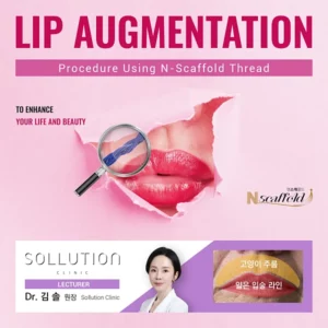 Lip Augmentation - Procedure Using N-Scaffold Thread by 솔 원장_엔스캐폴드_엔코그_featured